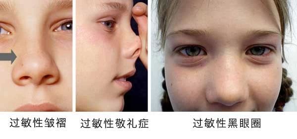 過敏性鼻炎會(huì)讓孩子變傻？！家長(zhǎng)該如何應(yīng)對(duì)